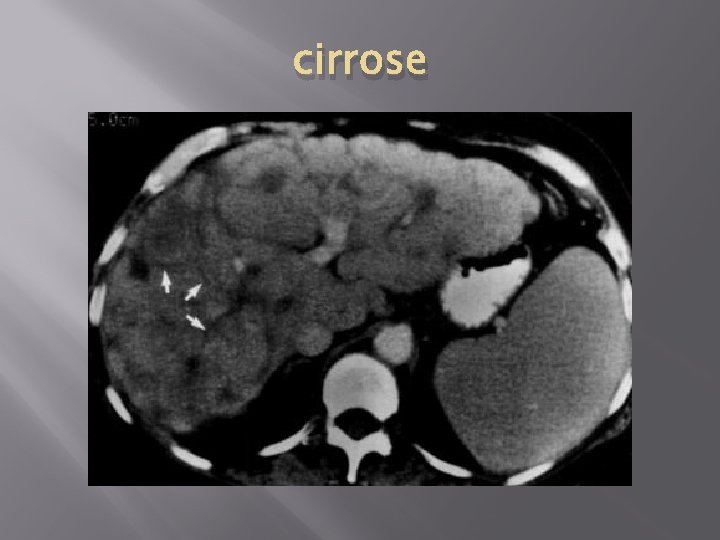 cirrose 