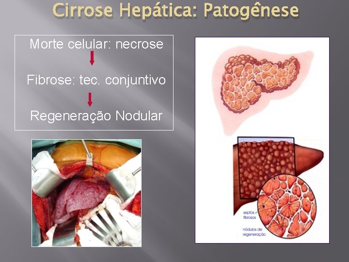 Cirrose Hepática: Patogênese Morte celular: necrose Fibrose: tec. conjuntivo Regeneração Nodular 