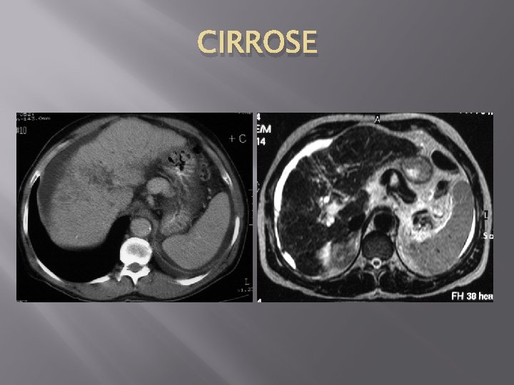 CIRROSE 