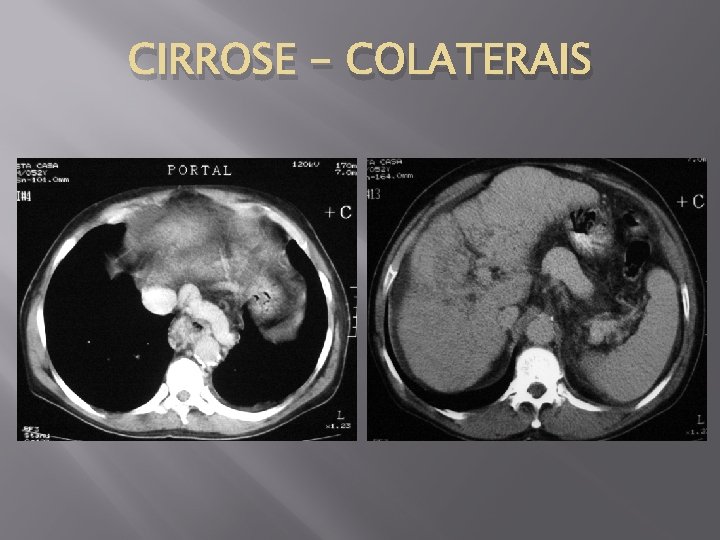 CIRROSE - COLATERAIS 
