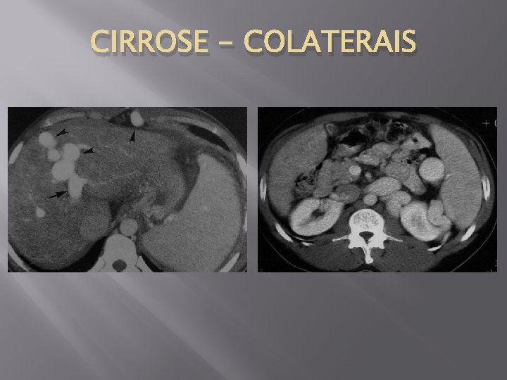CIRROSE - COLATERAIS 