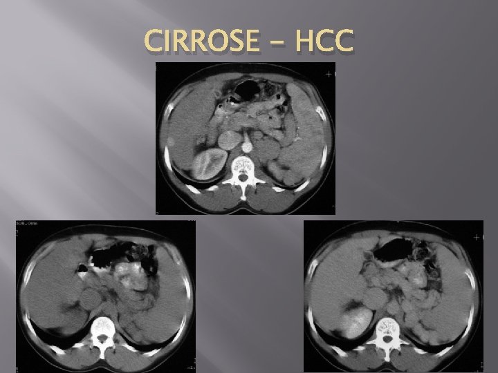CIRROSE - HCC 