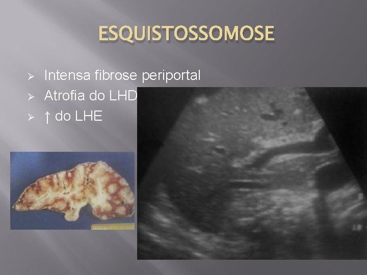 ESQUISTOSSOMOSE Ø Ø Ø Intensa fibrose periportal Atrofia do LHD ↑ do LHE 