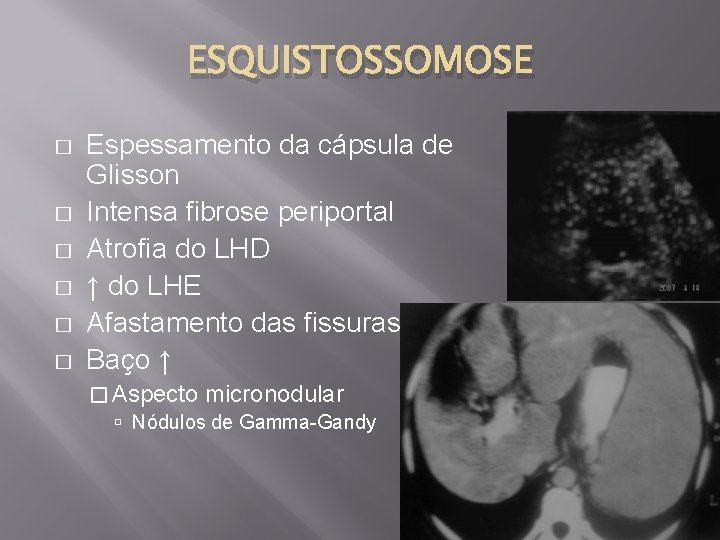 ESQUISTOSSOMOSE � � � Espessamento da cápsula de Glisson Intensa fibrose periportal Atrofia do