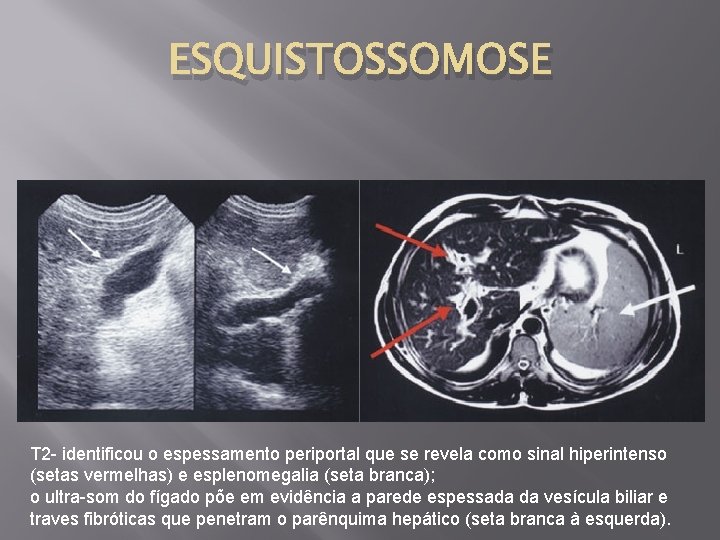 ESQUISTOSSOMOSE T 2 - identificou o espessamento periportal que se revela como sinal hiperintenso