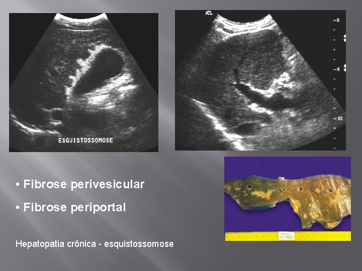  • Fibrose perivesicular • Fibrose periportal Hepatopatia crônica - esquistossomose 