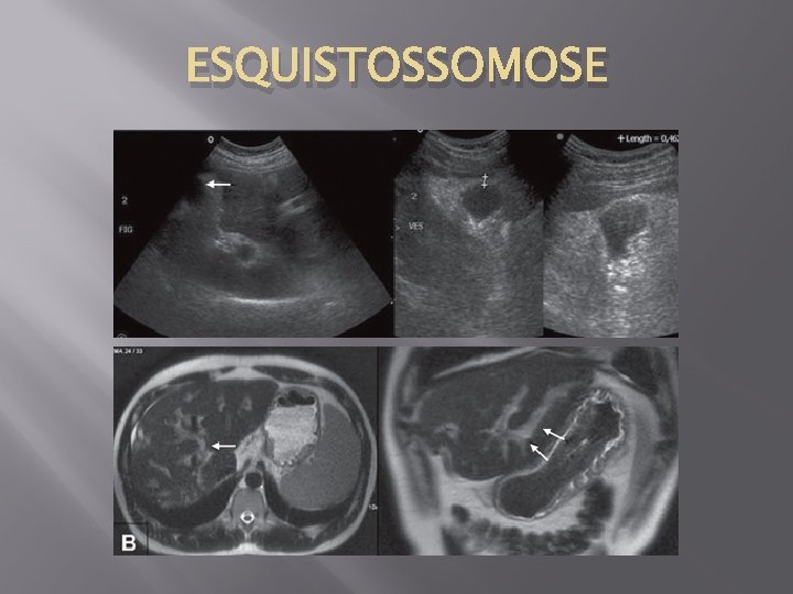 ESQUISTOSSOMOSE 