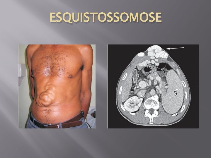 ESQUISTOSSOMOSE 