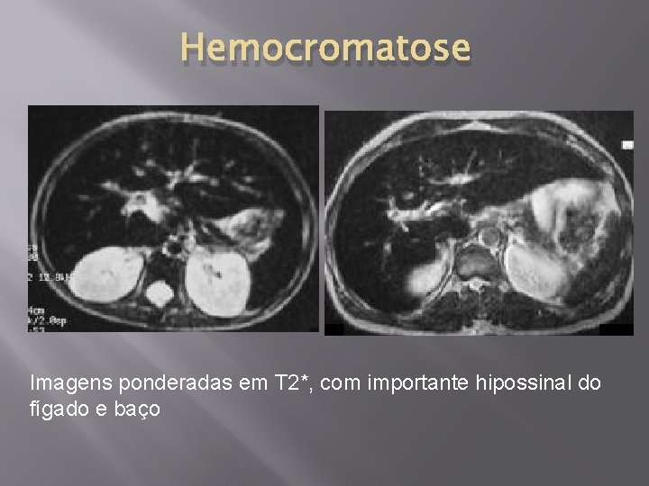 Hemocromatose Imagens ponderadas em T 2*, com importante hipossinal do fígado e baço 