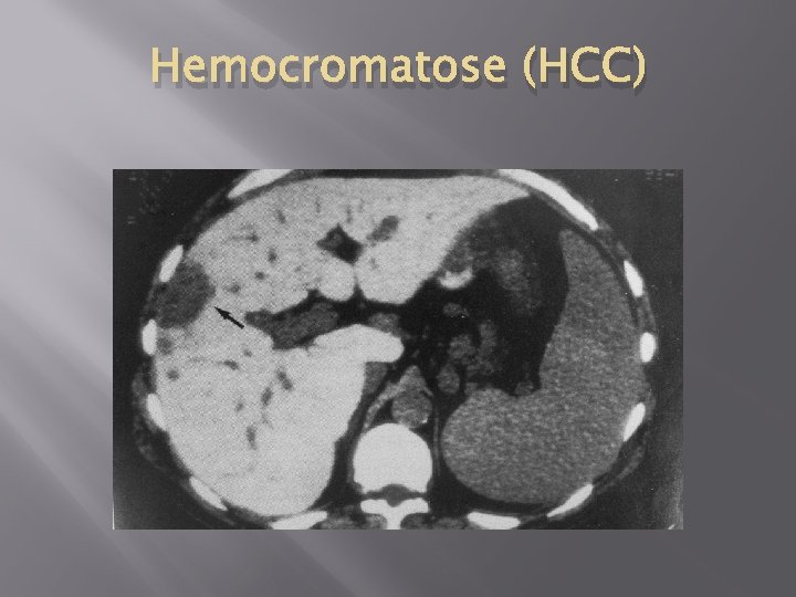 Hemocromatose (HCC) 