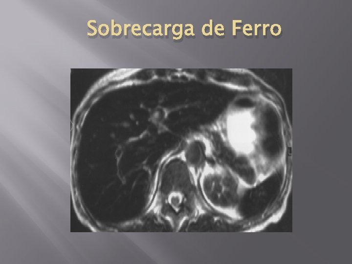 Sobrecarga de Ferro 