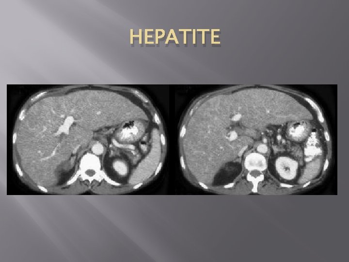 HEPATITE 