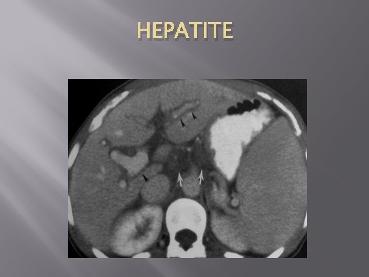 HEPATITE 