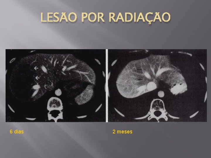 LESÃO POR RADIAÇÃO 6 dias 2 meses 