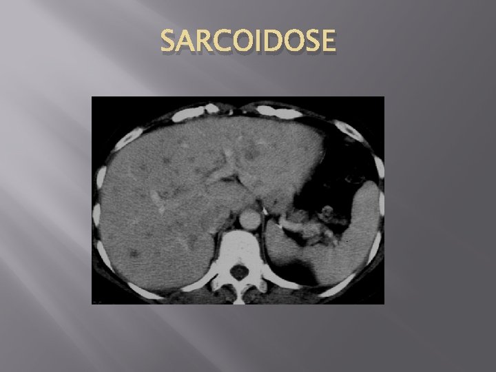 SARCOIDOSE 