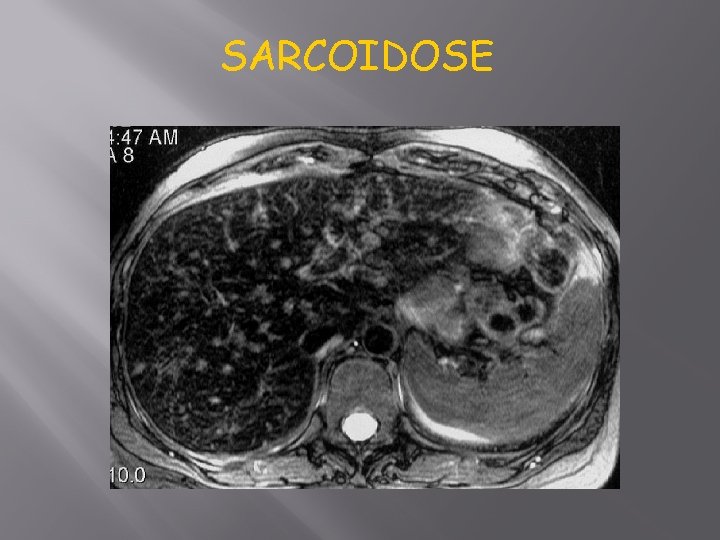 SARCOIDOSE 