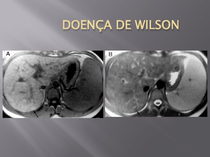 DOENÇA DE WILSON 