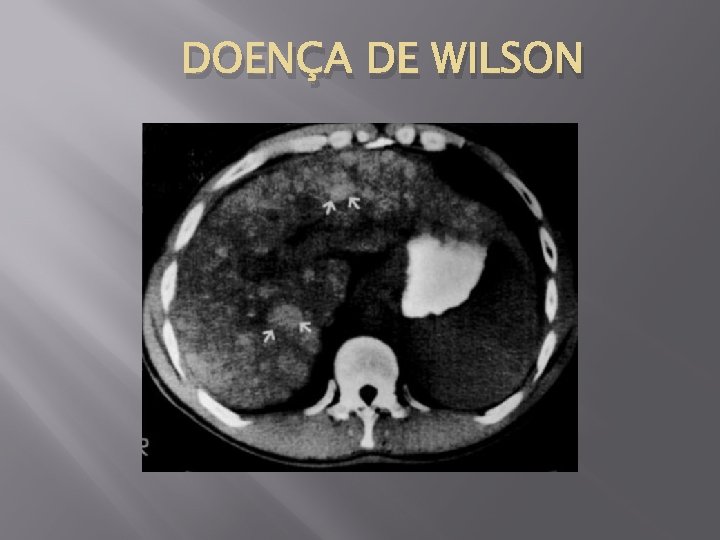 DOENÇA DE WILSON 