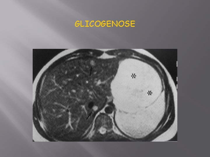 GLICOGENOSE 