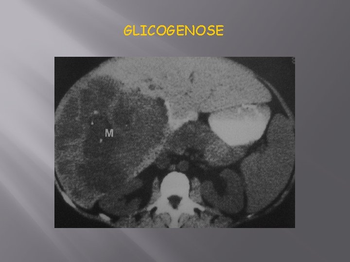 GLICOGENOSE 
