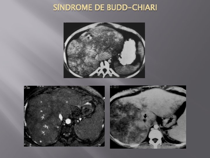 SÍNDROME DE BUDD-CHIARI 