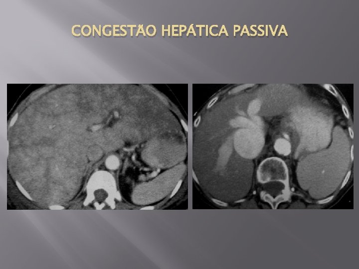 CONGESTÃO HEPÁTICA PASSIVA 