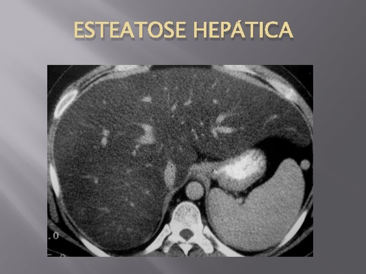 ESTEATOSE HEPÁTICA 