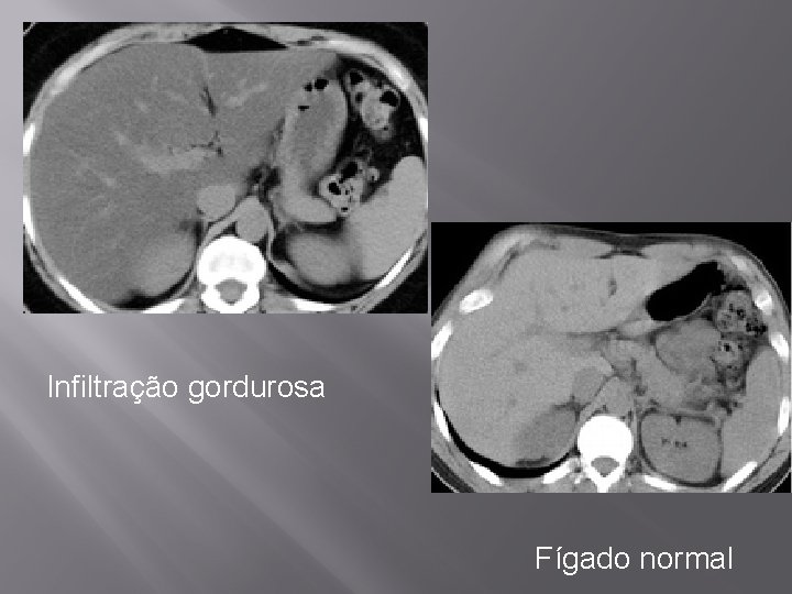 Infiltração gordurosa Fígado normal 