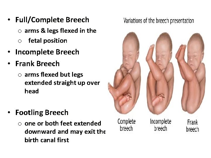  • Full/Complete Breech o arms & legs flexed in the o fetal position