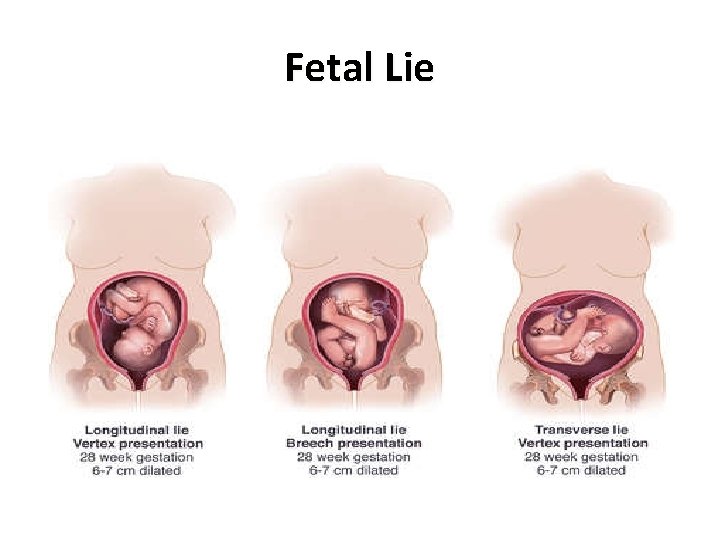 Fetal Lie 