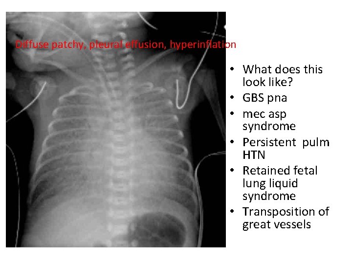 Diffuse patchy, pleural effusion, hyperinflation • What does this look like? • GBS pna