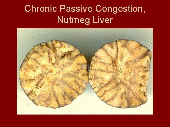 Chronic Passive Congestion, Nutmeg Liver 