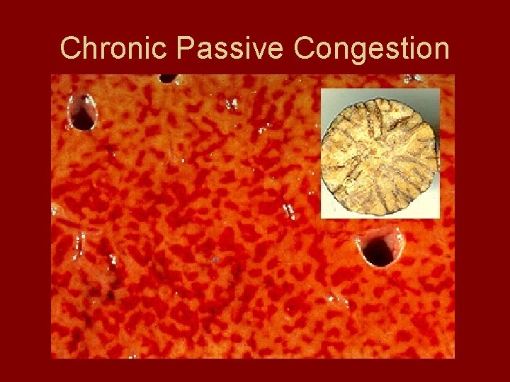 Chronic Passive Congestion 
