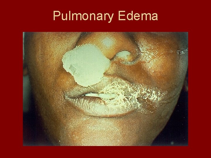 Pulmonary Edema 