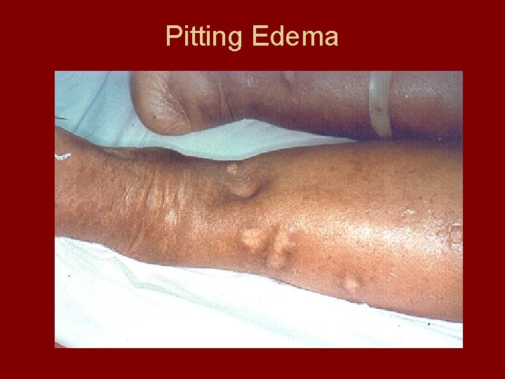 Pitting Edema 