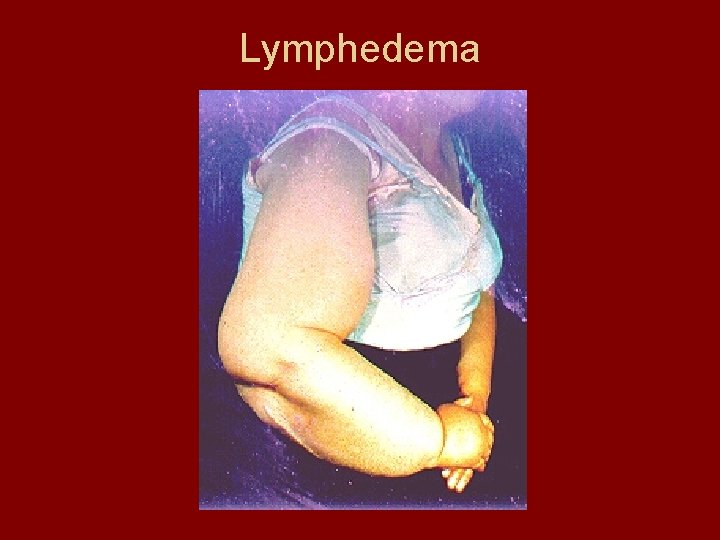 Lymphedema 