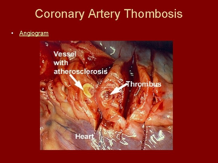 Coronary Artery Thombosis • Angiogram 