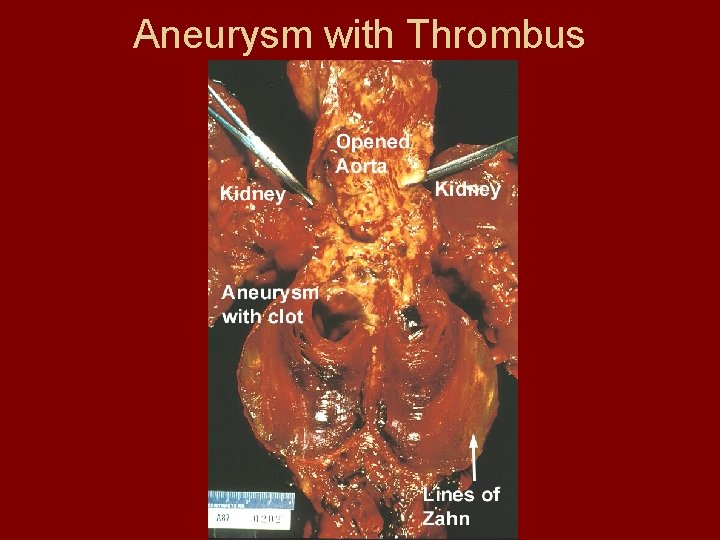 Aneurysm with Thrombus 