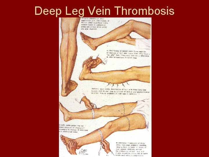 Deep Leg Vein Thrombosis 