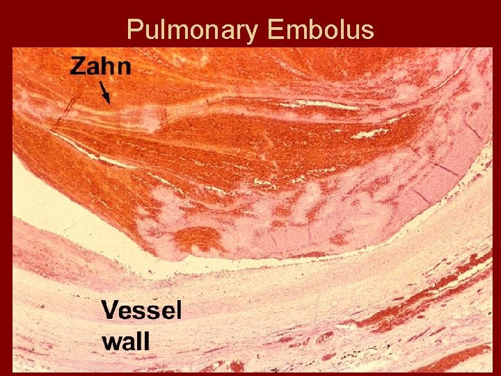 Pulmonary Embolus 