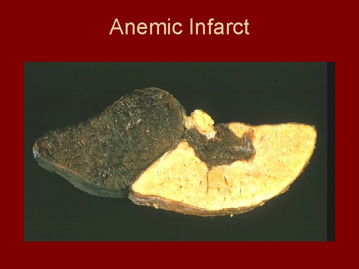 Anemic Infarct 