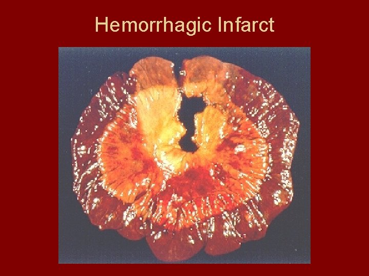 Hemorrhagic Infarct 