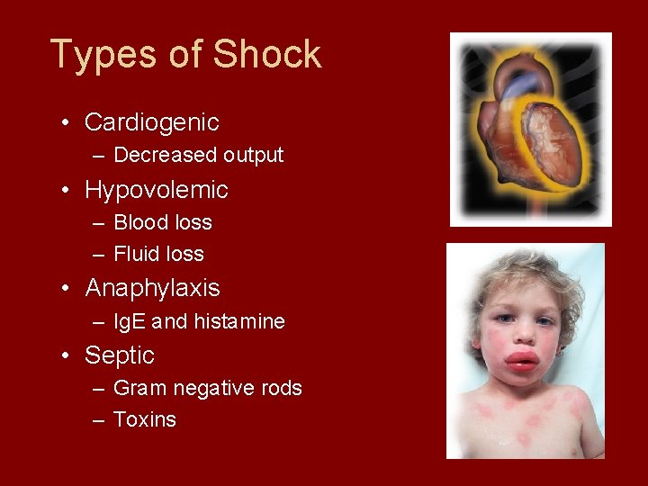Types of Shock • Cardiogenic – Decreased output • Hypovolemic – Blood loss –