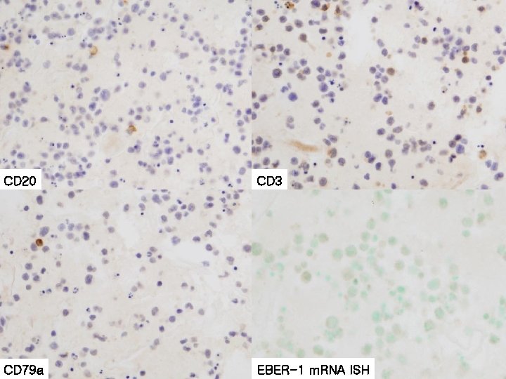 CD 20 CD 3 CD 79 a EBER-1 m. RNA ISH 