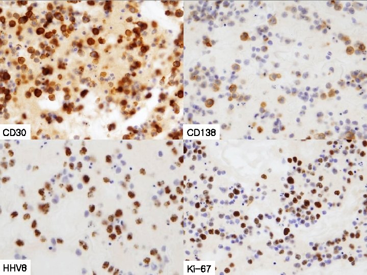 CD 30 CD 138 HHV 8 Ki-67 