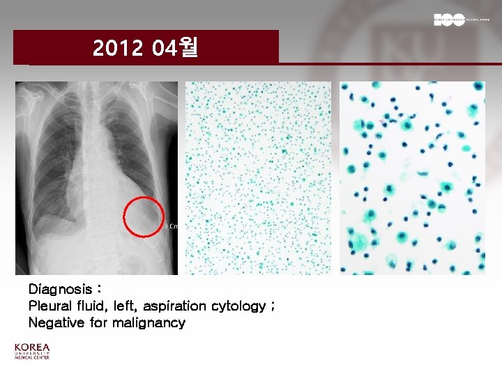 2012 04월 Diagnosis : Pleural fluid, left, aspiration cytology ; Negative for malignancy 