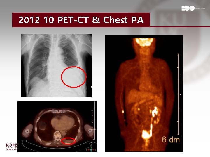 2012 10 PET-CT & Chest PA 