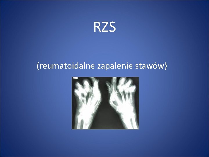RZS (reumatoidalne zapalenie stawów) 