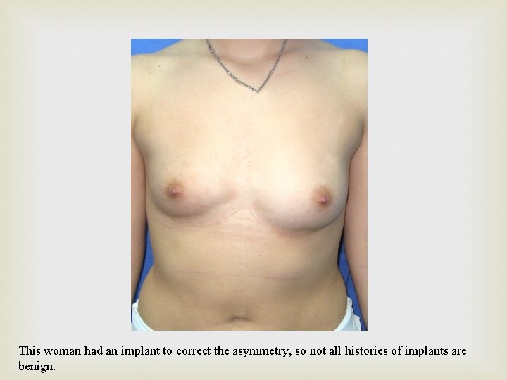 This woman had an implant to correct the asymmetry, so not all histories of