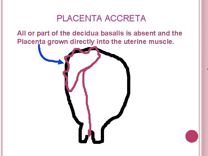 PLACENTA ACCRETA All or part of the decidua basalis is absent and the Placenta PLACENTA ACCRETA All or part of the decidua basalis is absent and the Placenta